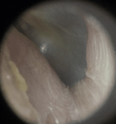 Ear Wax Removal Procedure ear canal after