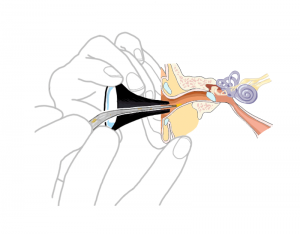 Ear wax removal diagram