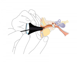 Ear wax removal diagram