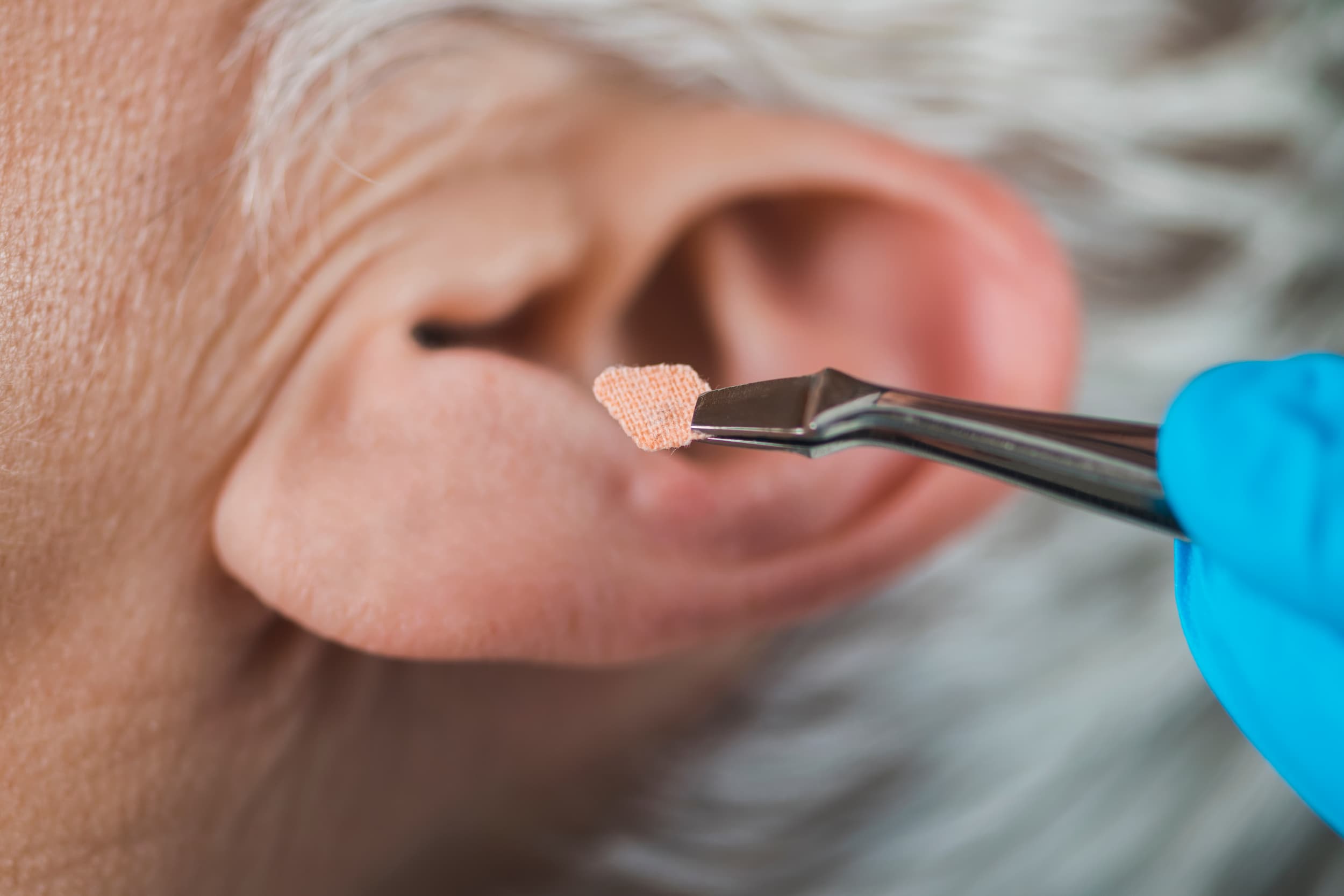 Close-up of ear with medical tweezers during earwax removal procedure
